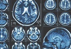 Стареющий мозг: не скукоживается, а «сползает» — и это гораздо интереснее, чем мы думали