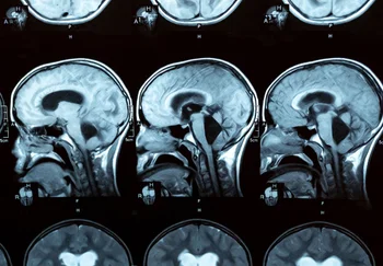 Когда мозг начинает «ругаться» сам с собой: как два заклятых соседа предсказывают приход Альцгеймера