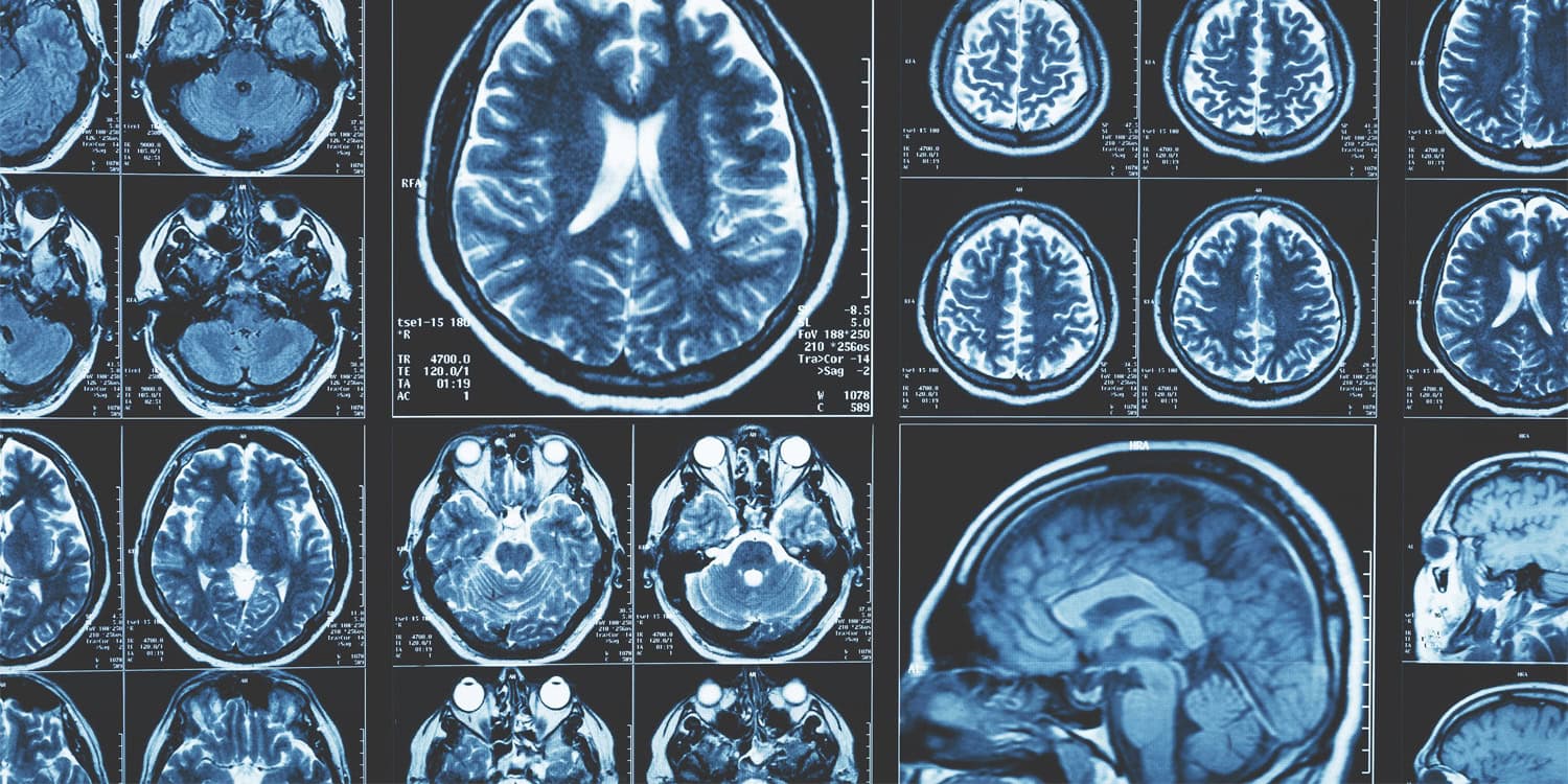 Стареющий мозг: не скукоживается, а «сползает» — и это гораздо интереснее, чем мы думали